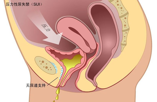 盆底康復(fù)之慢肌、快肌訓(xùn)練篇